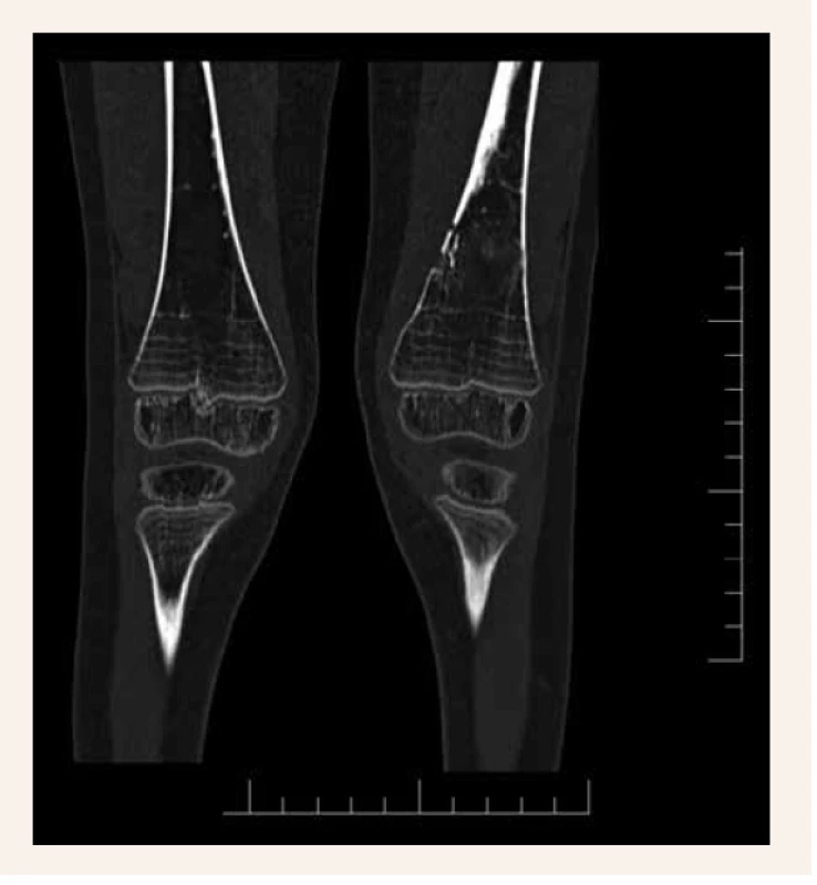 Osteolytické ložisko mediálnej hrany distálnej
diametafýzy ľavého femoru