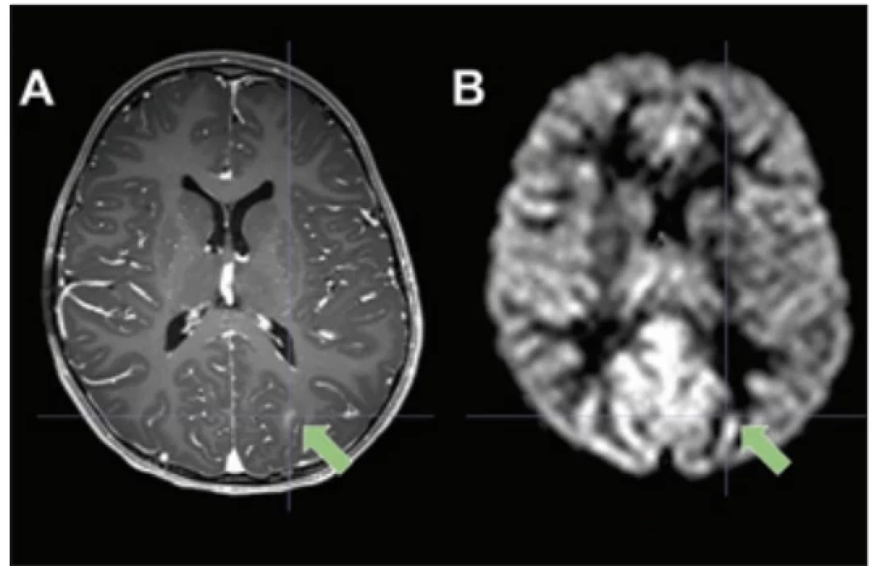 Tříletá pacientka s lézionální epilepsií (FCD 2b). Zelená šipka ukazuje na epileptogenní lézi. (A) Postkontrastní T1-vážený obraz. (B) ASL
(3D PCASL, 5 PLD) CBF mapa, patrná hyperperfuze v parieto-okcipitální oblasti. Data získána
ve Fakultní nemocnici Motol. Three-year-old female patient with
lesional epilepsy (FCD 2b). The green arrow

points to the epileptogenic lesion. (A) Post-con-
trast T1-weighted image. (B) ASL (3D PCASL,

5 PLD) CBF map, showing hyperperfusion
in the parieto-occipital region. Data acquired
at the Motol University Hospital.