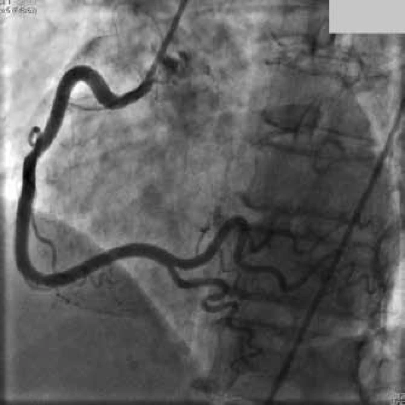Normální angiogram pravé koronární tepny