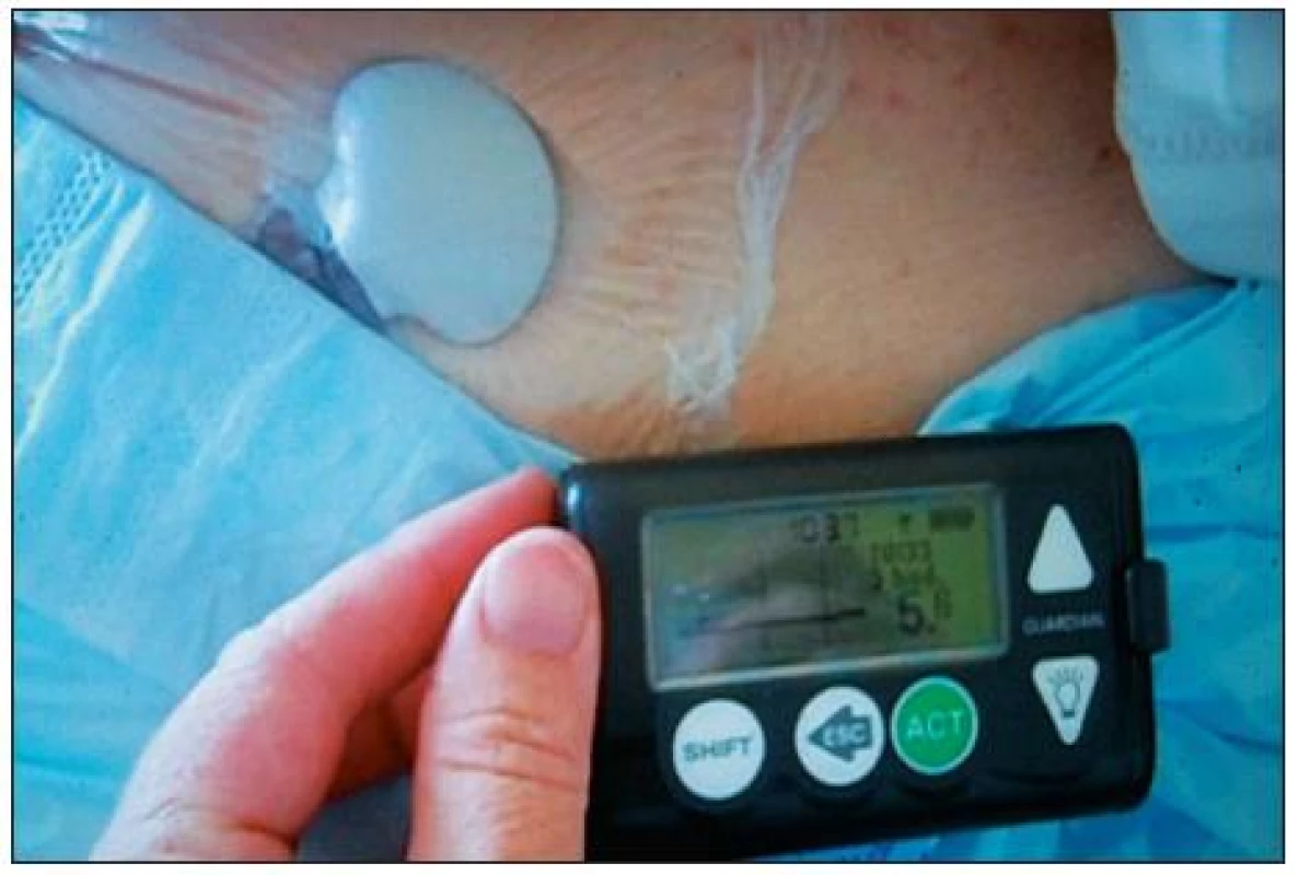 Zavedený senzor s transmitterem přelepený náplastí, monitor Guarrdiian<sup>®</sup> REAL-Tiime CGMS firmy Medtronic (foto autorka)
