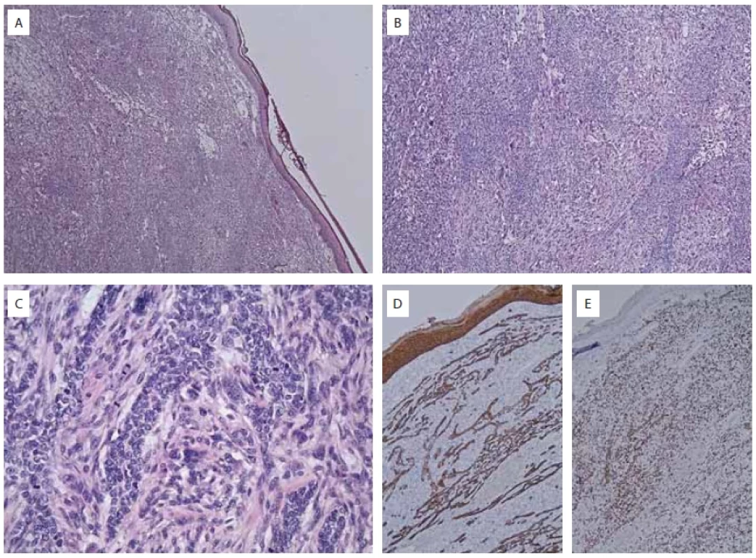 Iconography pathology HE and IHC with comments.