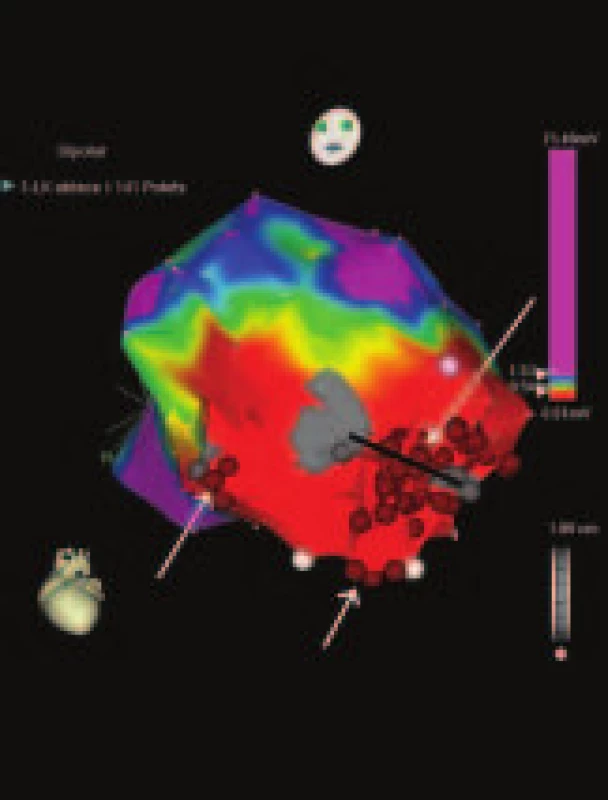 CartoXP – voltážová mapa oblasti hrotu a bázy ľavej komory. 
Sivé zóny – jazvovité tkanivo s minimálnou amplitúdou. Šípky označujú oblasti aplikácie RF ablačnej energie (červené body). Medzi dvoma oblasťami fibrózy je viditeľný kanál tkaniva so spomaleným vedením, ktorý je potrebné abláciou eliminovať – čierna línia (archív autorov).