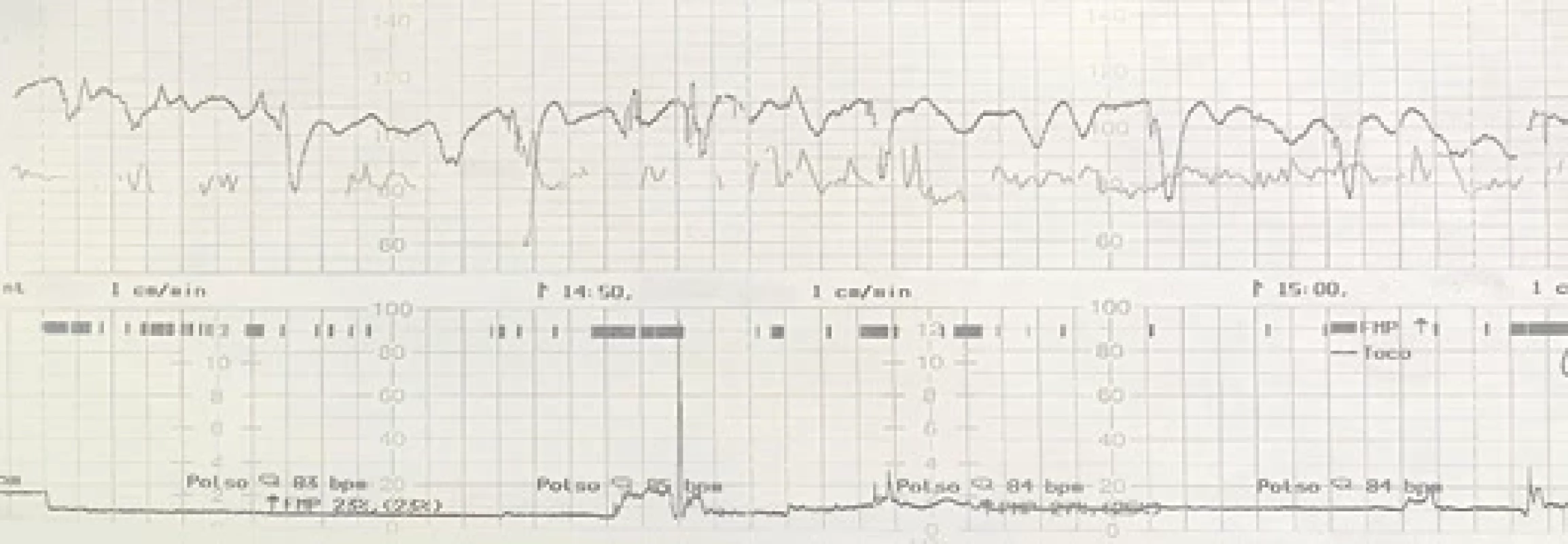 Electronic fetal monitoring documenting an ominous pattern (agonal) according to ACOG Class III classifi cation.</br>Obr. 1. Elektronické monitorování plodu dokumentující nepříznivý (agonální) stav podle klasifi kace ACOG III. třídy.
