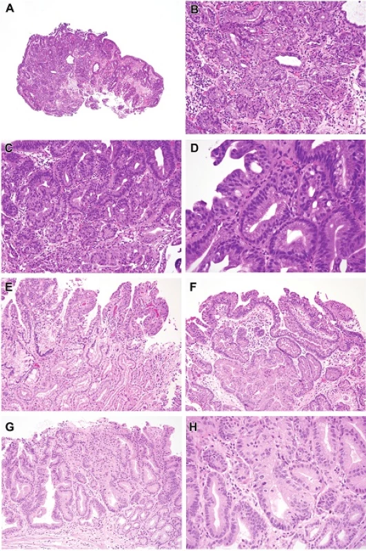 A. Pyloric/cardiac gland dysplasia. This lesion presented as a nodule. The closely packed tubules with focal pit dilatation and relatively pale appearance are features of pyloric gland differentiation. H&amp;E (40x). B. This is an example of lowgrade pyloric dysplasia, showing closely packed tubules with “ground glass” cytoplasm rather than foveolar type neutral mucin, and also have small round uniform basal nuclei. H&amp;E (100x). C. High-grade dysplasia. The nuclei are less hyperchromatic than those in intestinal and foveolar type dysplasia. In this example, they have become large and have become stratified at the top of the field with focal cribriform pattern (middle right edge of photograph). H&amp;E (200x). D. Detail shows a gland in the center with low-grade features but to the left the features are those of high-grade dysplasia with pyloric differentiation. Nucleoli are visible left and bottom.H&amp;E (400x). E. The lower part of the field shows low-grade pyloric dysplasia whereas the top shows high-grade features with more pleomorphic nuclei that lose polarity. H&amp;E (100x). F. Pyloric/cardiac gland dysplasia intramucosal carcinoma. This example show a few low-grade glands and the right, high-grade dysplastic changes on the surface and sufficiently complex cribriform architecture in the center to diagnose intramucosal carcinoma. H&amp;E (100x). G. Pyloric/cardiac gland dysplasia, intramucosal carcinoma. The cribriform zone in the center has effaced the lamina propria.H&amp;E (100x) H. This is a detail of the zone in question from Figure 4G. The gland in the center shows complex crypt budding, a feature of early invasion.H&amp;E (200x).