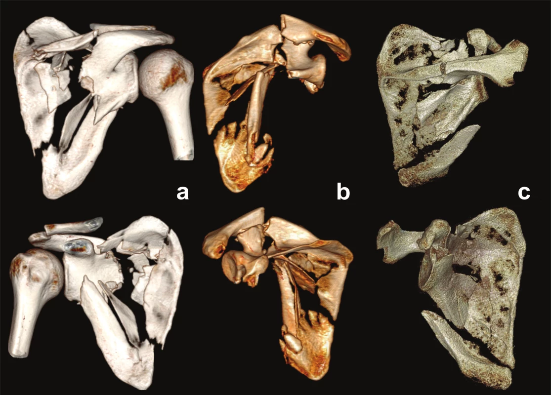 Fracture of both pillars, types of glenoid fragment
a – glenoid fragment carrying lateral spine/acromion and coracoid process; b – glenoid fragment carrying coracoid process; c - glenoid fragment without processes.