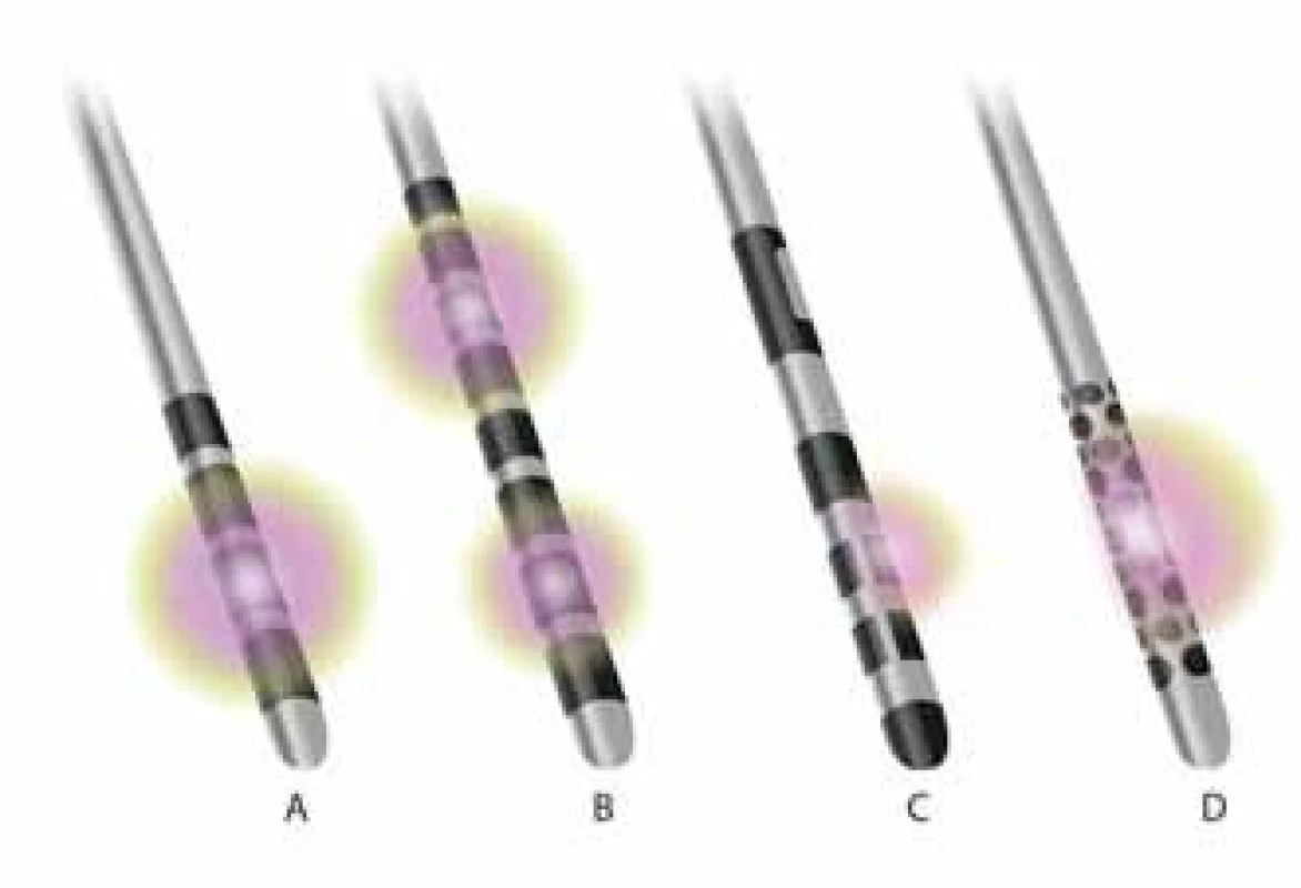 Druhy stimulačných DBS elektród (upravené podľa propagačných materiálov Medtronic a Boston Scientific). A – konvenčná kvadrupolárna elektróda, B – okta - polárna elektróda s možnosťou nastavenia viacerých nezávislých stimulačných úrovní, C – multipolárna elektróda s možnosťou nastavenia nezávislých stimulačných úrovní a s možnosťou špecifického tvarovania elektrického poľa, D – multipolárna elektróda s možnosťou špecifického tvarovania elektrického poľa.
Fig. 2. Deep brain stimulation electrode configuration (modified version of advertising material – Medtronic and Boston Scientific). A – conventional quadripolar electrode, B – octapolar electrode enabling the allocation of multiple different stimulation parameters, C – multipolar electrode allowing directional steering of the electric field and enabling the allocation of completely different stimulation parameters independently to each electrode contact, D – multipolar electrode that allows specifical steering of the field, reducing the potential for stimulation- induced side effects.