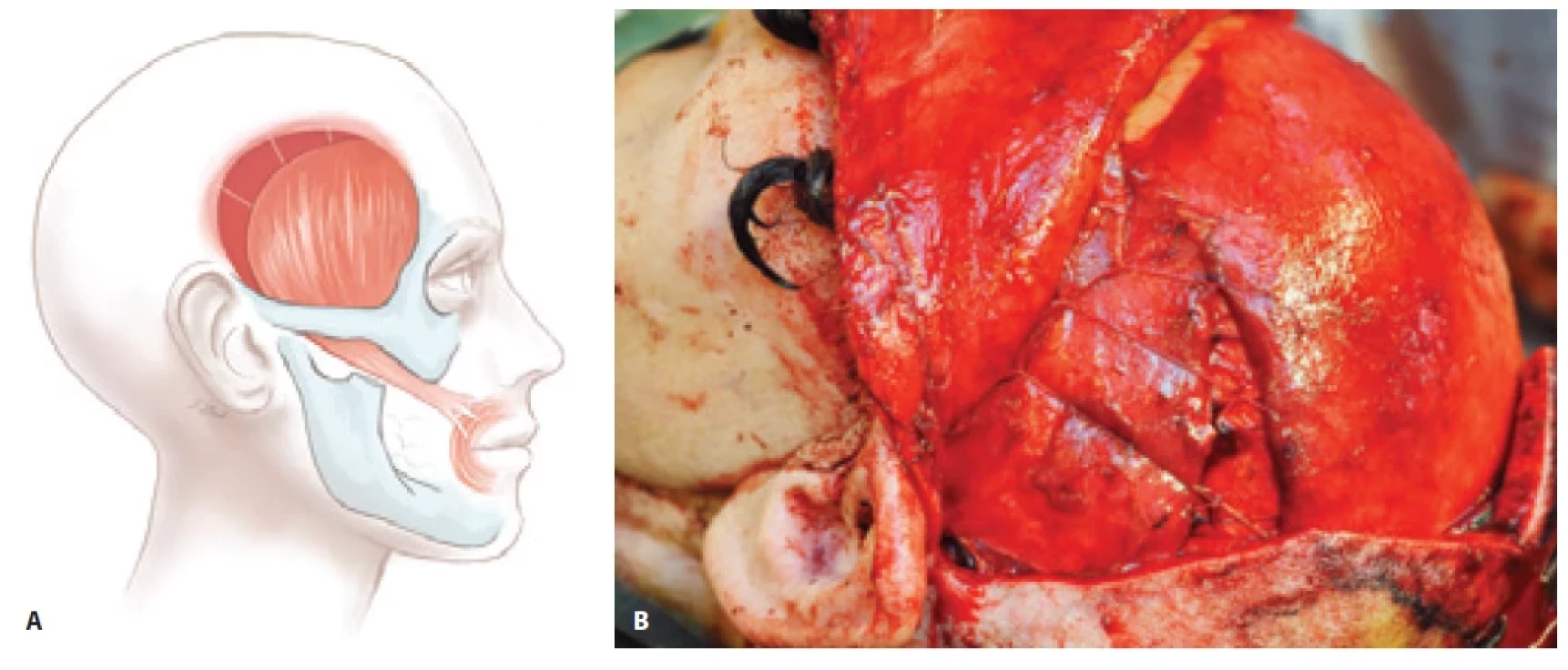 Lengthening temporalis myoplasty: A) Principle of the surgery shown in the schematic illustration; B) re-fi xation of the temporal muscle to the ventral part of the temporal fossa with adjustment of the tension in consideration of the position of the nasolabial fold.