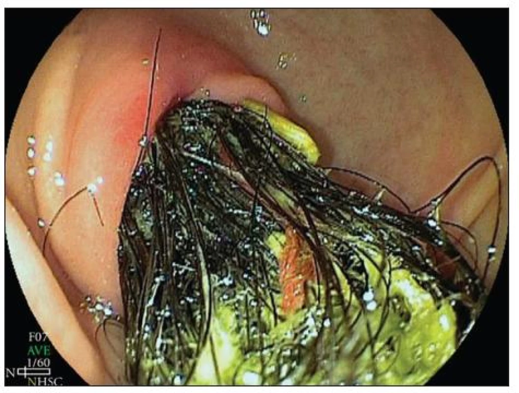 Endoskopický obraz – Rapunzelin syndrom. Zdroj [10]
Fig. 3. Endoscopic view – Rapunzel syndrome. Source [10]