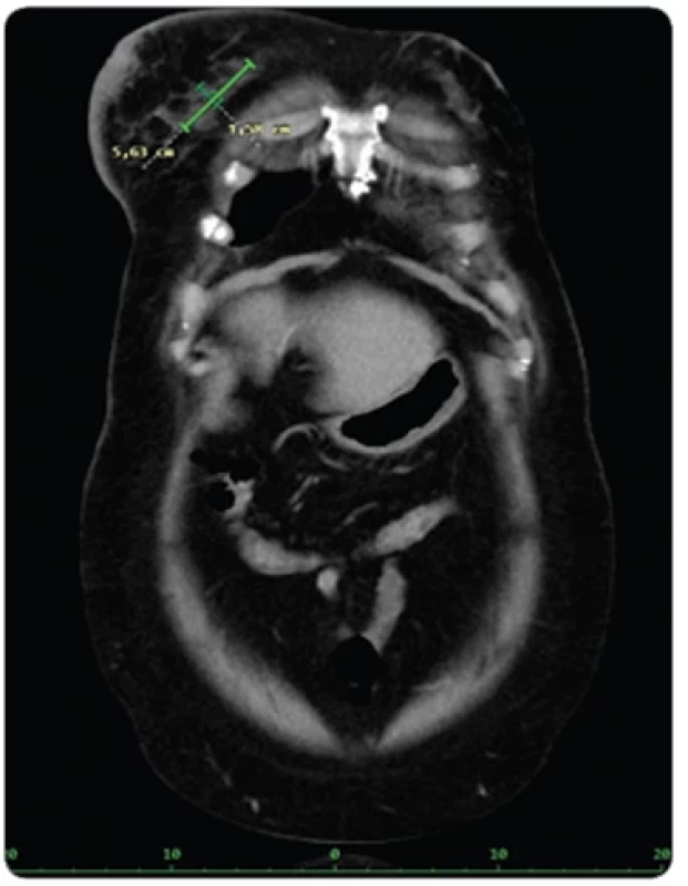 Snímek CT z 12/23. Závěr: dle kritérií Response Evaluation Criteria in Solid Tumors došlo k částečné regresi postižení se zmenšením ložisek v pravém prsu a v pravém nadklíčku. Zmenšil se podkožní uzel pod levou lopatkou a mírně se zmenšila jedna hypodenzita v játrech. Změny ve skeletu jsou stacionární.