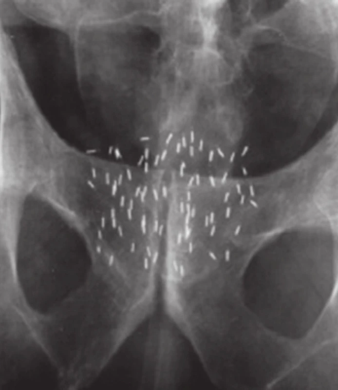 Permanentní brachyterapie, jodová zrna v prostatě 
Fig. 7. Permanent brachytherapy, iodine seeds in the prostate