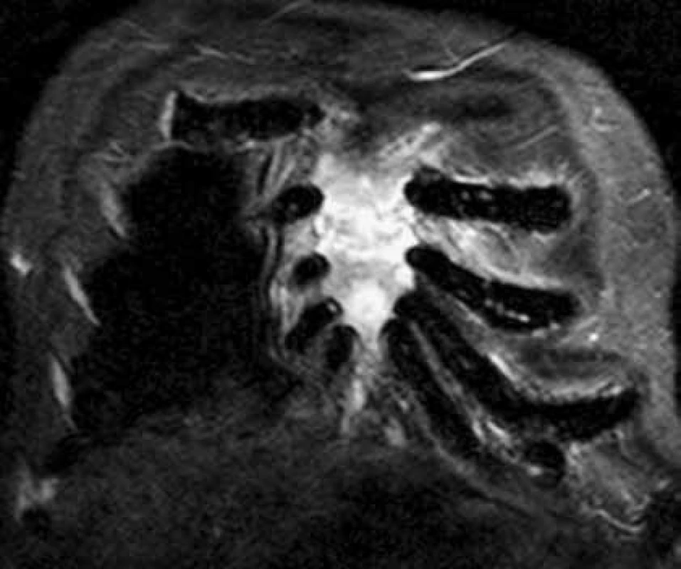 Současné CT a MR vyšetření hrudníku u pacienta s bolestmi hrudního koše a monoklonální gamapatií.
Standardní RTG zobrazení skeletu u tohoto pacienta neprokazovalo vůbec žádné známky mnohočetného myelomu, zatímco na MR a CT je již zřetelný obraz pokročilé nemoci, vyžadující léčbu. Tyto snímky ilustrují, že v případně bolesti páteře a kostí u člověka s monoklonální gamapatií je nutno při negativním nálezu na klasickém RTG provést další doplňující vyšetření.