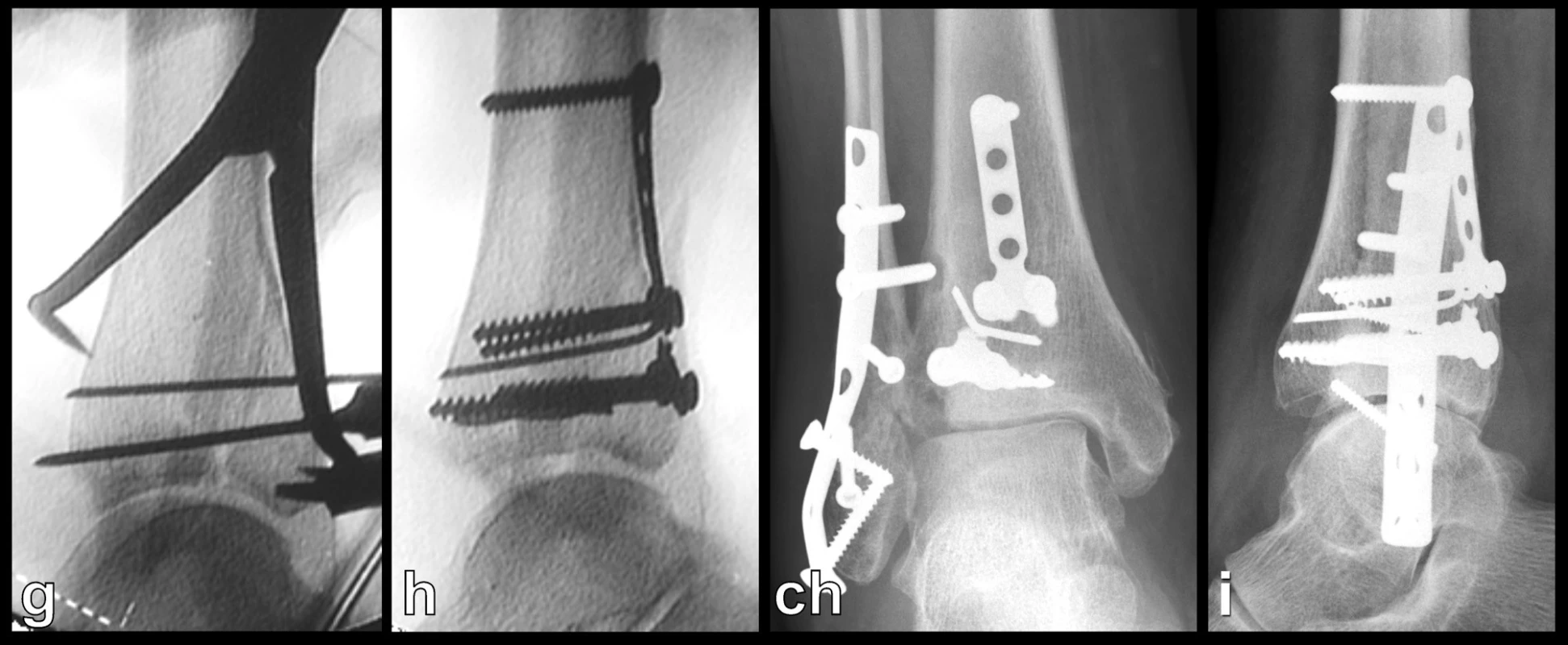 Osteosyntéza odlomené zadní hrany tibie – Typ 2 (posteromediální) a, b, – rtg snímky ukazující zlomeninu fibuly Weber B, odlomení zadní hrany nesoucí téměř polovinu kloubní plochy distální tibie a subluxaci talu dorzálně, c – transverzální CT řez, d – sagitální CT řez, e – 3D CT rekonstrukce, dorzální pohled, f – 3D CT rekonstrukce, mediální pohled, z rekonstrukcí je patrné, že je odlomena zadní hrana až k sulcus malleolaris a laterálně dorzální polovina incisury tibie, g, h – peroperační rtg snímky ukazují postupnou rekonstrucki distální tibie, ch, i – rtg snímky po operaci
