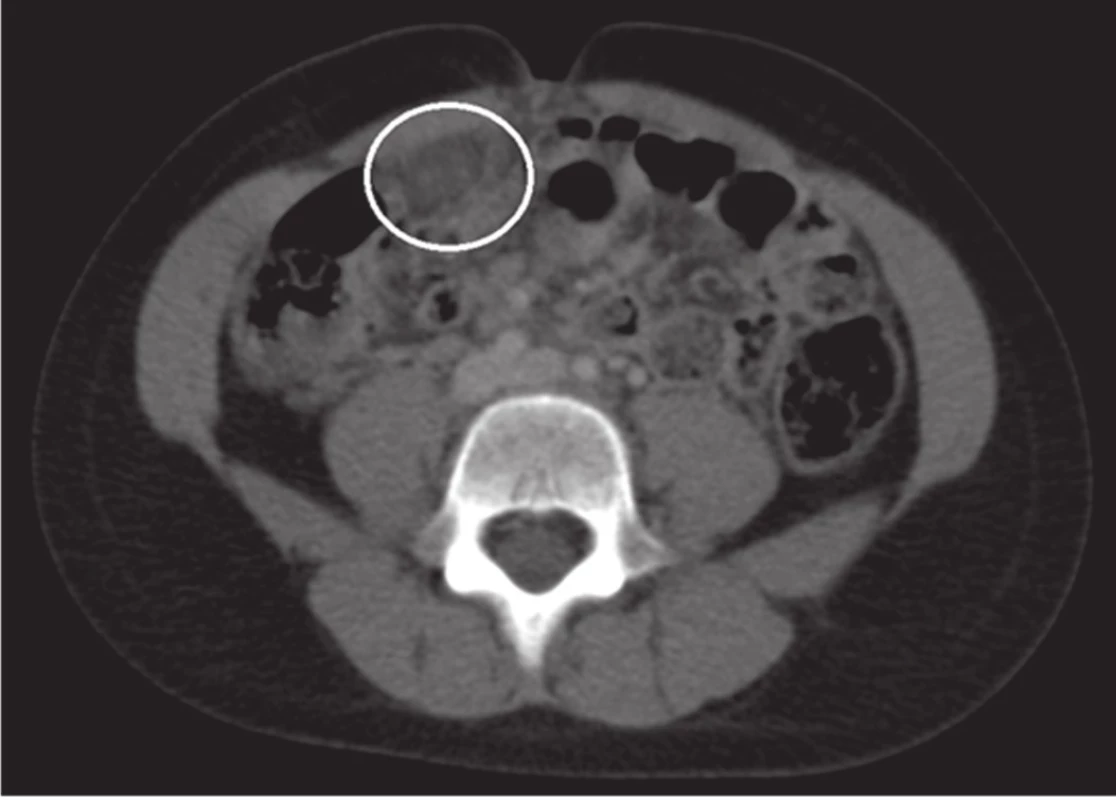 Primární torze omenta - axiální řez
Fig. 1 Primary omental torsion - axial slice