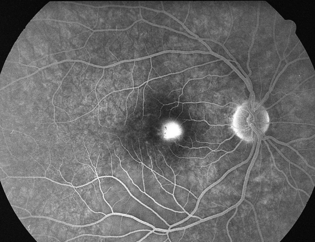 Pac. č. 1: Fluoresceínová angiografia PO: pericentrálne pri č. 3 bod presakovania