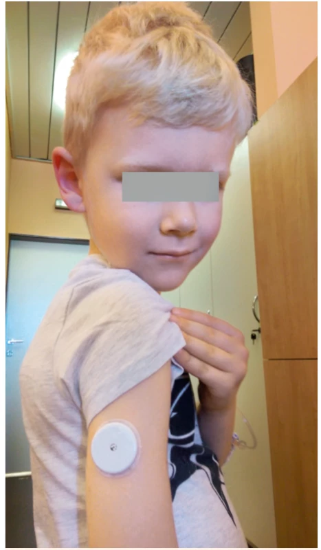 Senzor pro kontinuální monitorování glykémie
FreeStyle Libre (Abbott) zavedený osmiletému
chlapci s diabetem 1. typu.