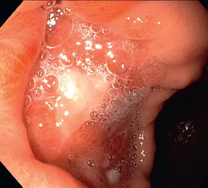Gastroskopický obraz karcinomu po neoadjuvantní chemoimunoterapii, s centrální nekrózou, histologicky pouze obraz jizvení.