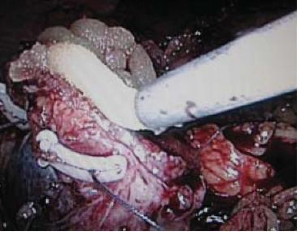 Aplikace tkáňového lepidla (FloSeal) na resekční plochu. Hemostatické stehy na spodině fixované přes polymerové svorky („sliding–clip renorrhaphy“).