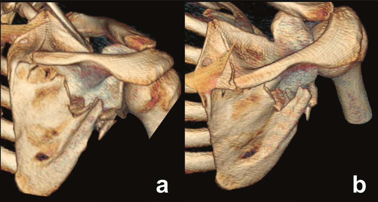 Fracture involving the medial third of the spinal pillar
a – posterior view, b – posterosuperior view.