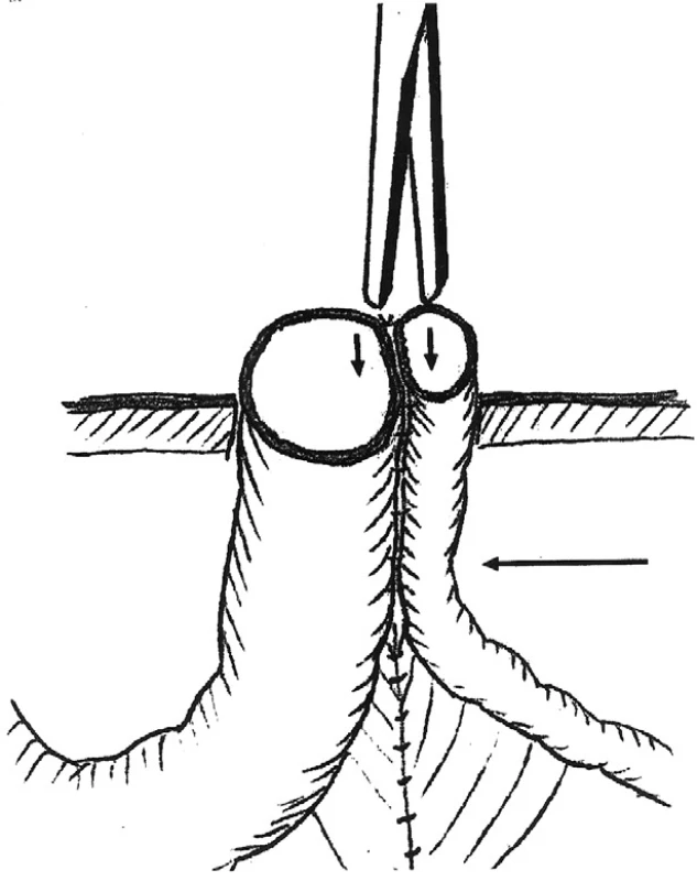 Schéma Grossovej metodiky s naznačeným uložením klemu, ktorý má urobiť tlakovú nekrózu
Fig. 2. The Gross method with indicated placement of a clam, expected to cause pressure necrosis