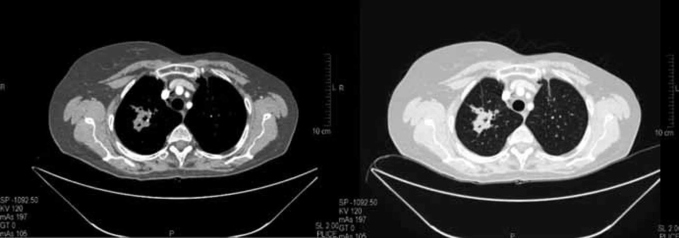 Kontrolní CT vyšetření plic po 6 měsících chemobioterapie v červnu 2010. Součet cílových lézí dle RECIST 59 mm (–30,5 %) splňující kritéria parciální regrese (PR).