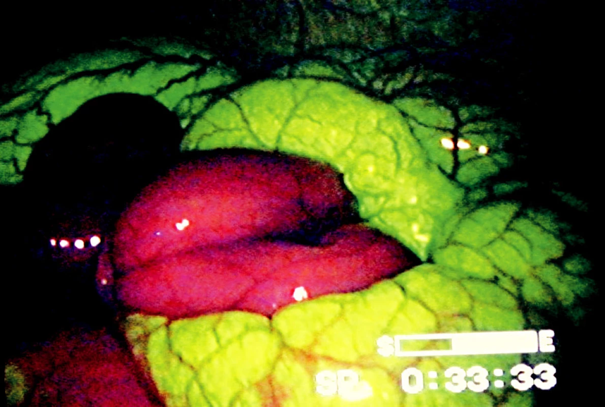 Laparoskopický obraz v UV světle po podání fluoresceinu. Vitální segmenty střeva emitují žlutozelenou luminiscenci, ischemické segmenty mají barvu tmavě fialovou
Fig. 4. Laparoscopic image under UV light after intravenous administering of fluorescien dye. Vital segments of bowel emit yellow green luminescence; ischemic segments have dark violet color