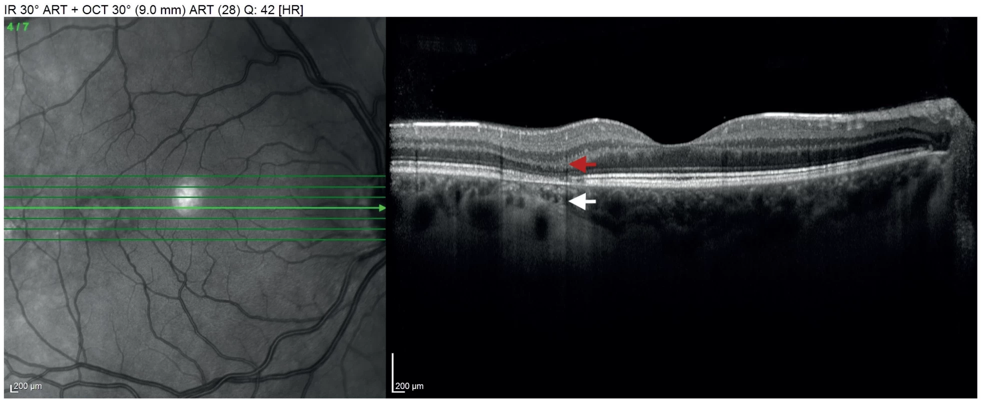 OCT macular scan of the right eye shows a reduction in the outer retinal layers and RPE (red arrow), as well as hyperreflectivity and thinning of the choroid (white arrow) in the torpedo maculopathy lesion