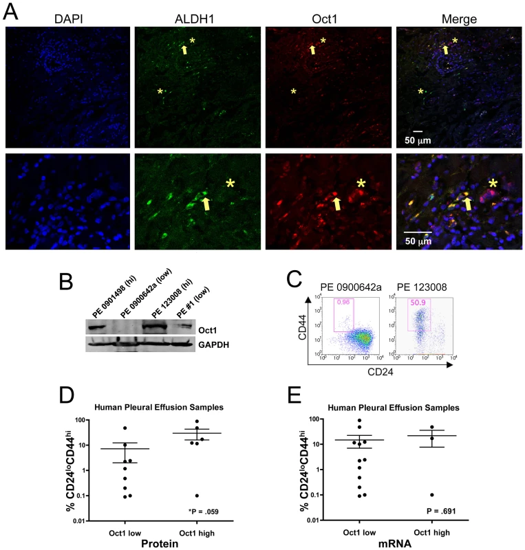 Oct1 protein levels correlate with a stem cell phenotype in primary human malignancy.