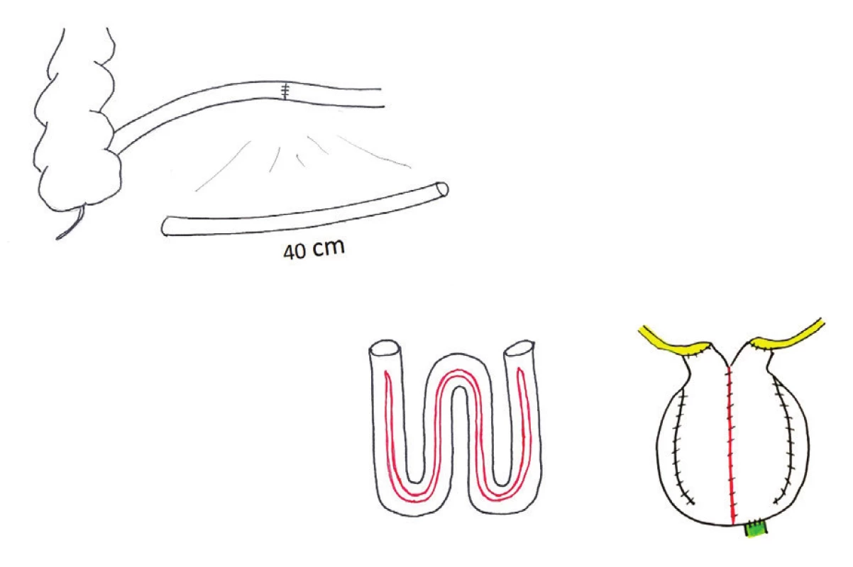 W-pouch, ileální ortotopická náhrada močového měchýře – schéma: exkludace 40 cm preterminálního ilea; detubularizace s ponecháním tubulárních segmentů na koncích délky 2−3 cm; konstrukce sférického pouche napojeného na pahýl uretry; přímá implantace ureterů do otevřených konců ilea
Fig. 4: W-orthotopic neobladder – diagram: 40 cm of excluded preterminal ileum, with two 2−3 cm chimneys at the ends, to which ureters are directly implanted