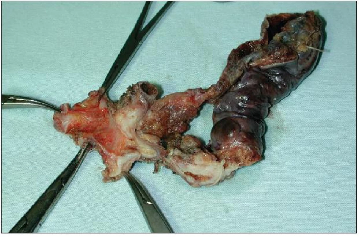 Resekát extrahepatálních žlučovodů a žlučníku s Klatskinovým tumorem sklerotizujícího typu klasifikace Bismuth I
Fig. 8: En bloc resection of extrahepatic biliary duct and cholecystectomy for sclerosing type of Klatskin tumor Bismuth I