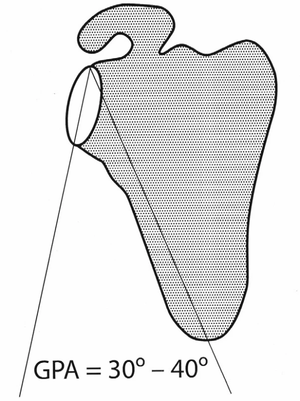 Glenoporální úhel. Normální hodnota je 30–40°
Fig. 2. Glenoporal angle. Normal value is 30–40 degrees