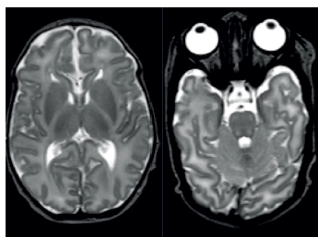 MR patologicky vysoký signál v zadních raménkách capsula interna na T2-vážených obrazech.
Fig. 3. MRI pathologically high signal in posterior bridge capsula interna in T2 high weight scan.