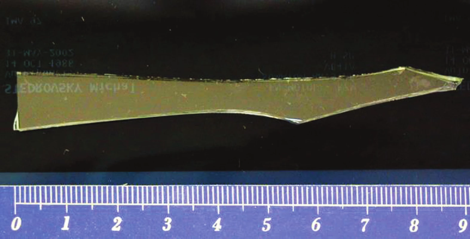 Odstraněný střep z jater velikosti 9 cm
Fig. 3: Removed glass fragment from liver, size of fragment 9cm