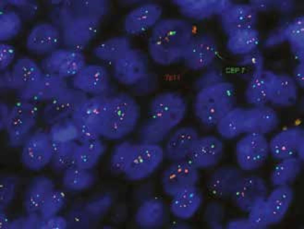 Polysomie chromozomu 7, použitá sonda KREATECH Diagnostic, ON EGFR, Her-1 (7p11)/SE 7