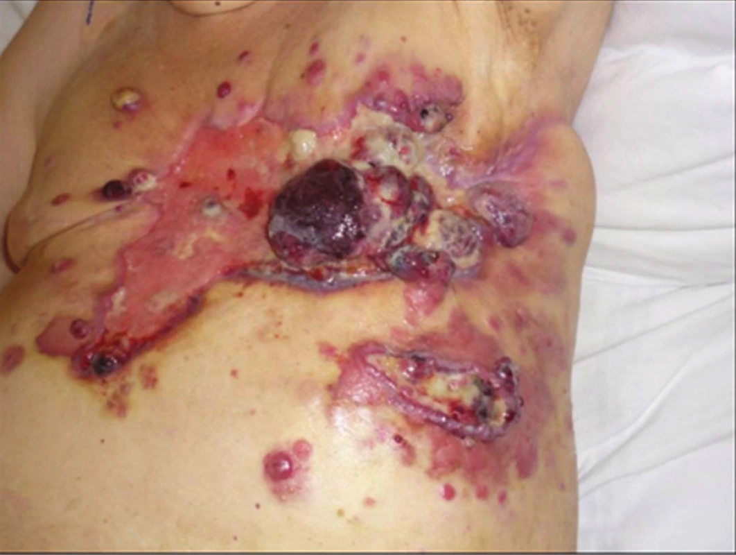 lokálně pokročilý radiací indukovaný angiosarkom prsu
Fig. 1: locally advanced radiation-induced angiosarcoma of the breast