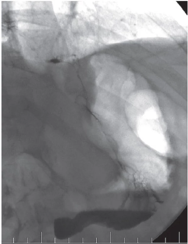 Pozice žaludku před propuštěním pacienta
Fig. 5: Position of the stomach before patient discharge