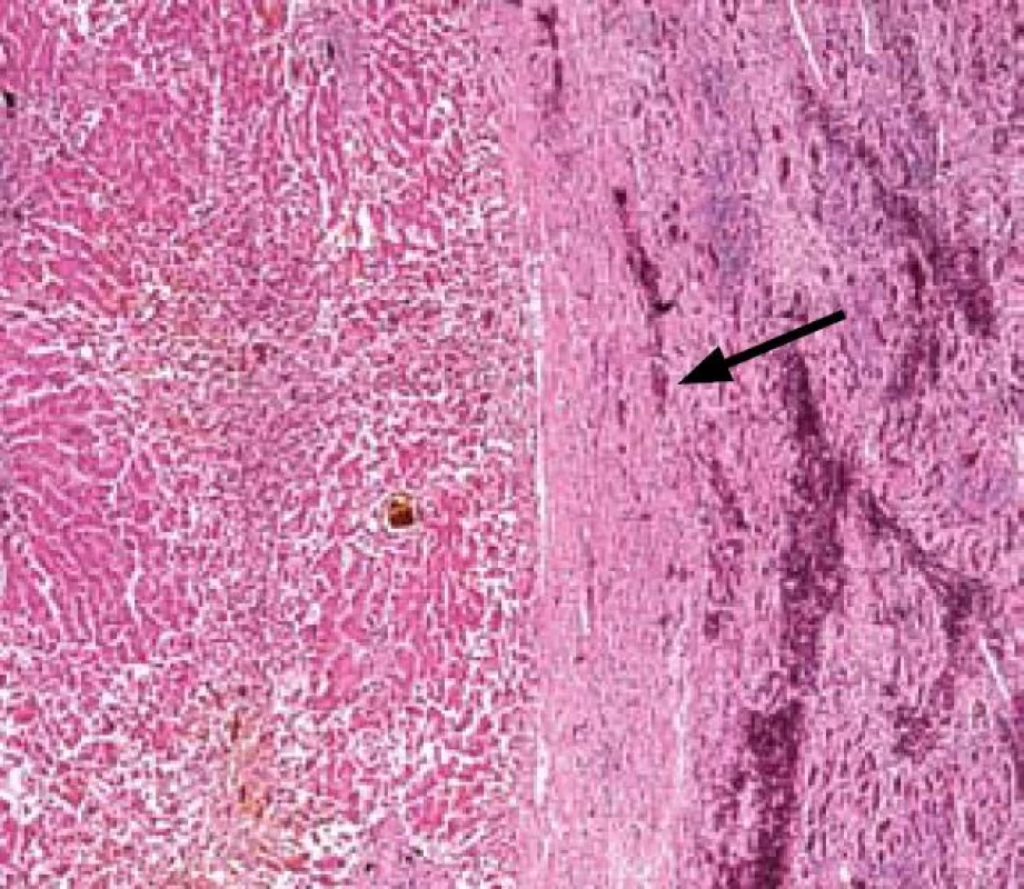 Přechod normální jaterního parenchymu a nádorové tkáně (označeno šipkou).
Fig. 1. Transition between normal liver parenchyma and tumour tissue (marked with an arrow).
