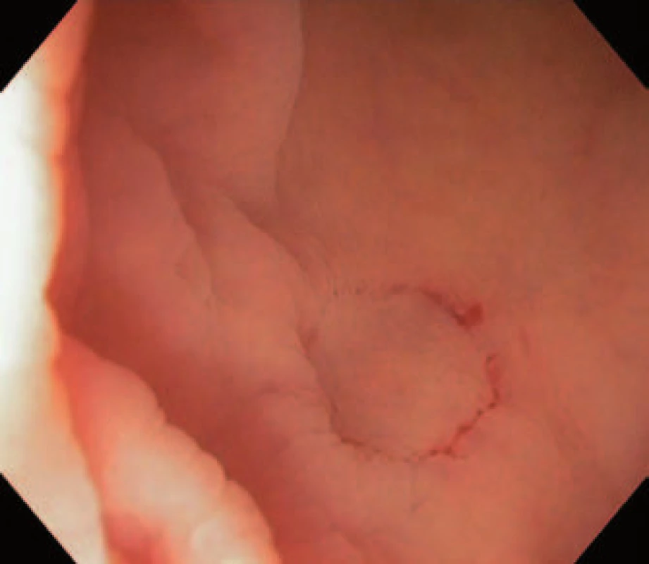 Sukční znamení na bázi céka.
Fig. 3. Suction mark in the cecum.