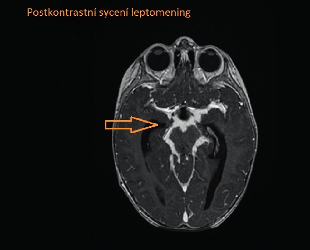Postkontrastní sycení leptomening.
Fig. 2. Leptomeningeal enhancement.