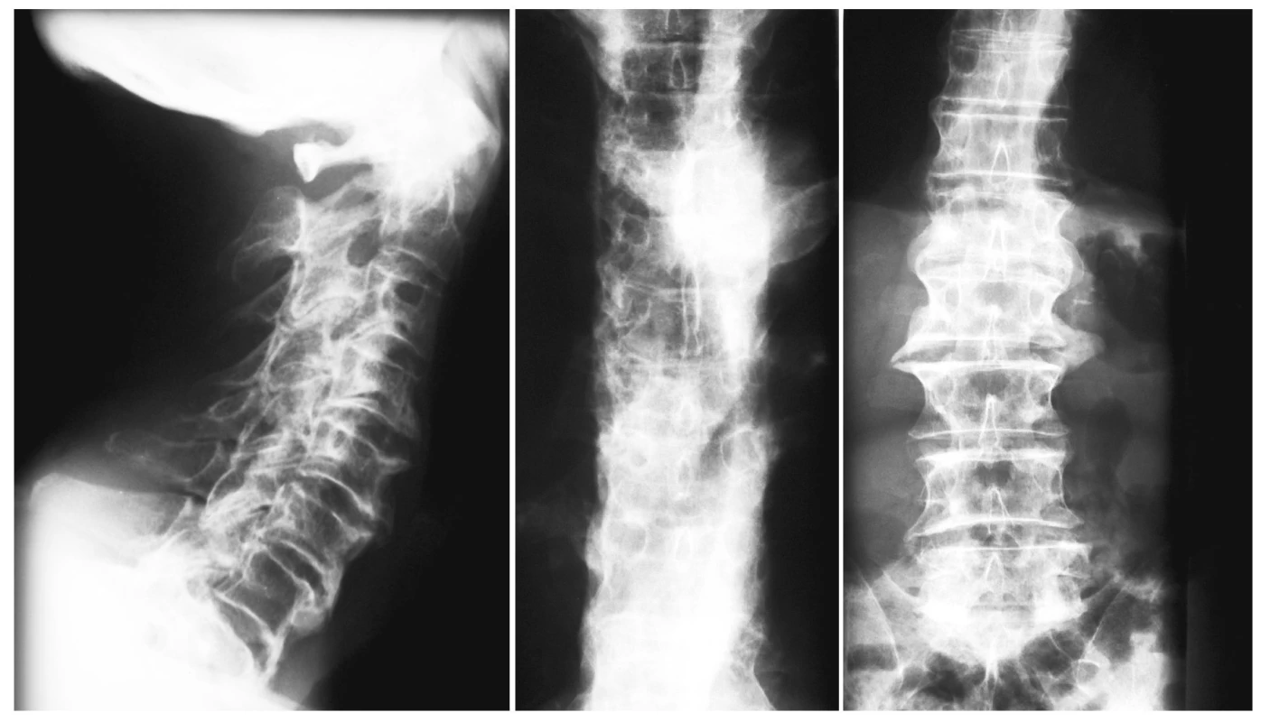 Pacient JŠ rtg C, Th, LS páteře – mohutné přemosťující osifikace.
