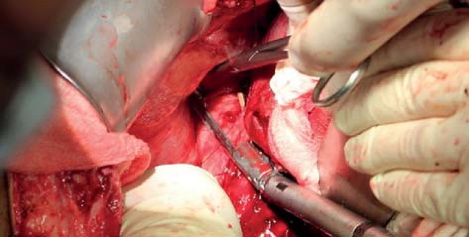 Nakládání vaskulárního stapleru na pravou jaterní žílu
Fig. 5: Division of right liver vein with vascular stapler