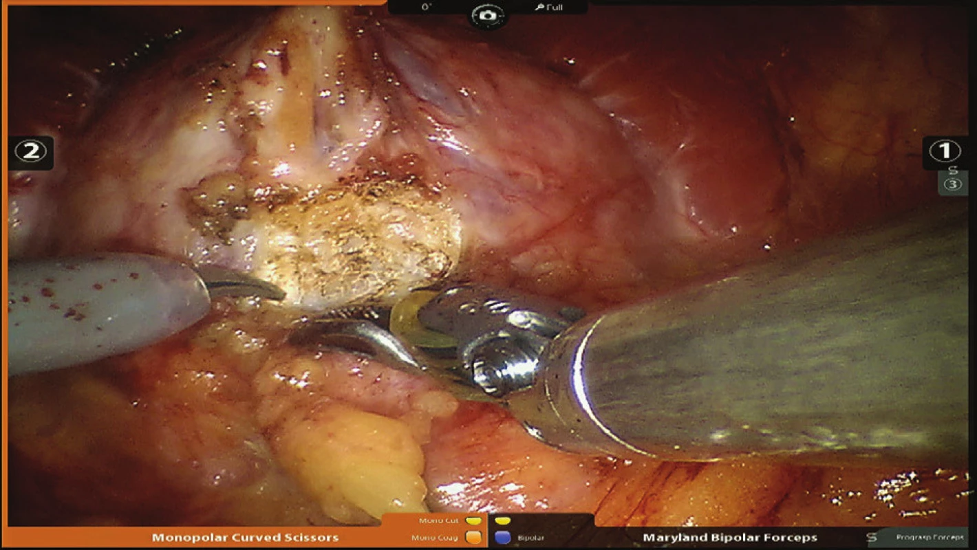 Identifikace hranice hrdla močového měchýře a prostaty
Fig. 2: Identification of the borderline of the bladder neck and the prostate