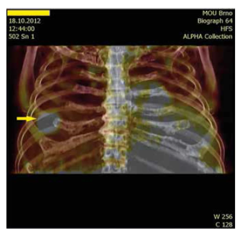 PET/CT 3 D fúze nádorového ložiska v hrudní stěně.