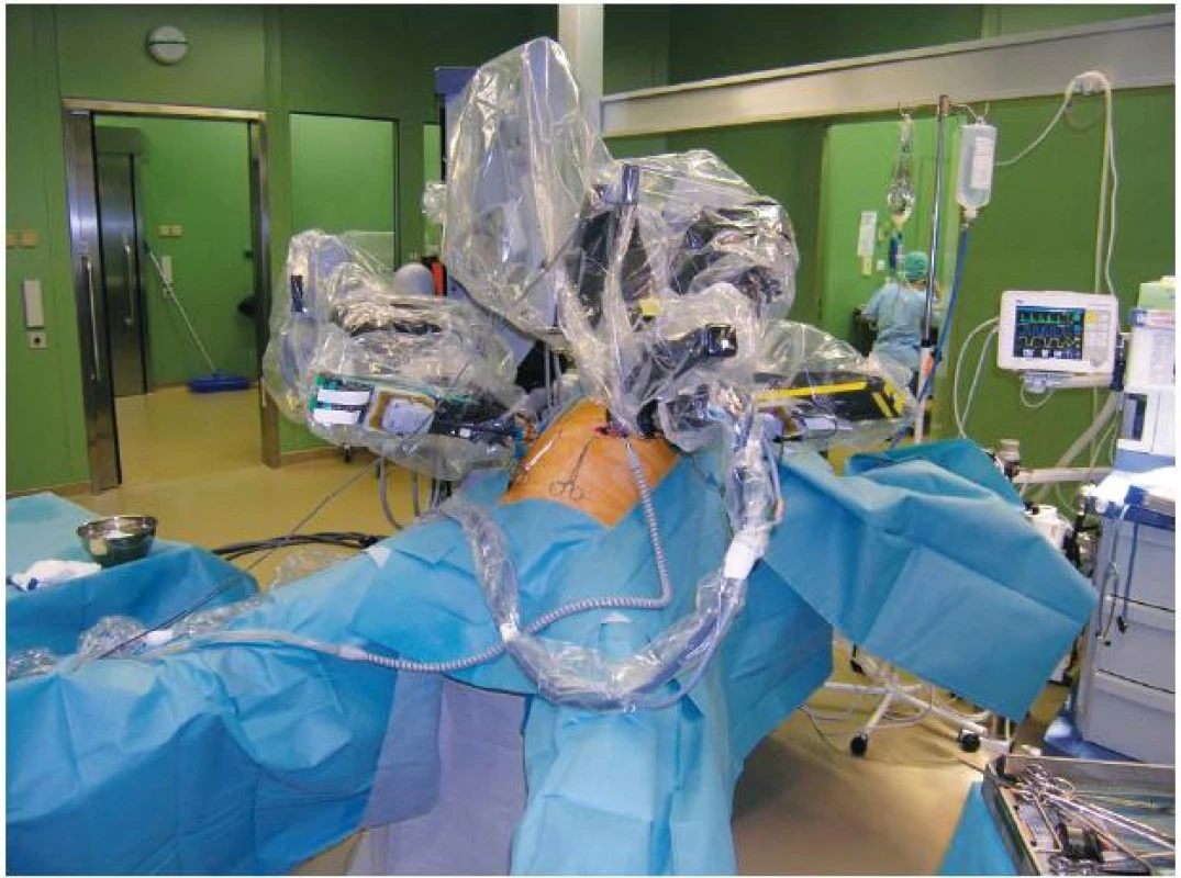 Robotická ramena s nástroji při operaci
Fig. 1: The robotic arms with instruments