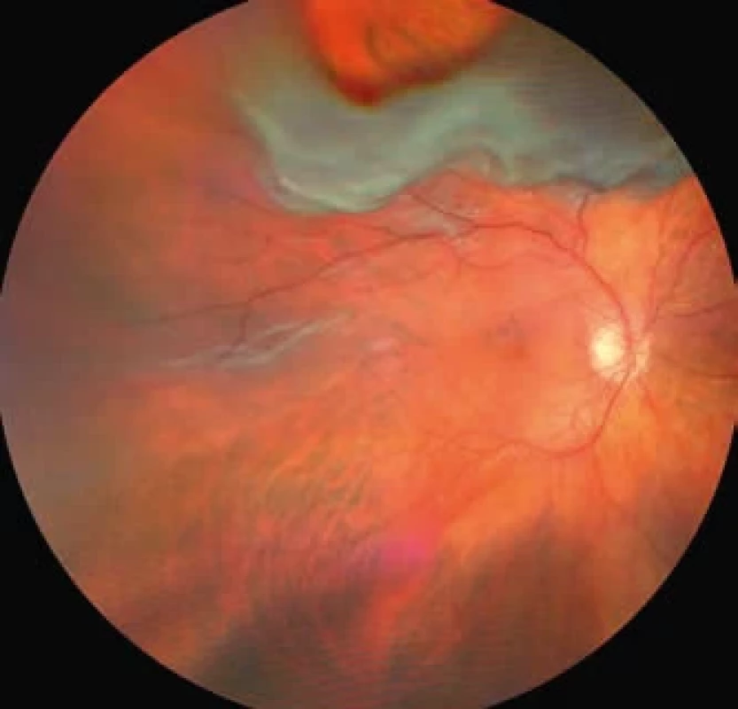 Odchlípení sítnice s retinální trhlinou. Retinal detachment with a retinal tear.