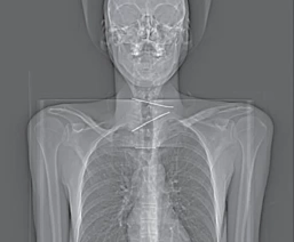 RTG. Topogram pacienta. </br>Fig. 1. RTG. Topogram of the patient.
