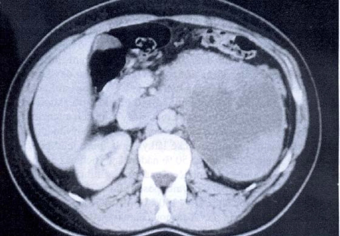 CT – tumor levé ledviny s trombem v renální žíle a dolní duté žíle.