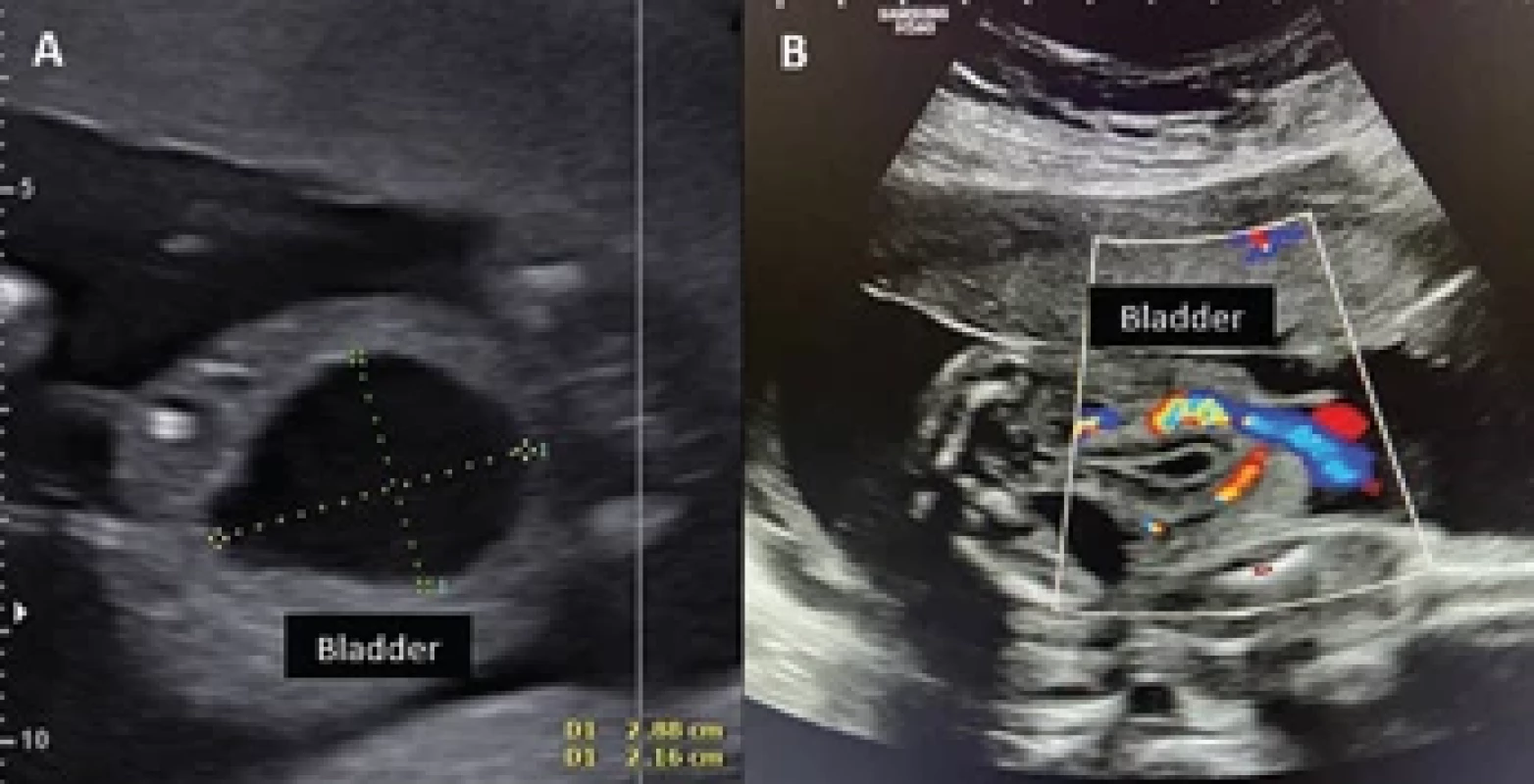 Ultrasound in the axial plane showing the fetal bladder 3 days (A) and 7 days with color Doppler (B) after laser fulguration of the posterior urethral valves. There was normalization of the amniotic fl uid volume and reduction of the bladder size.