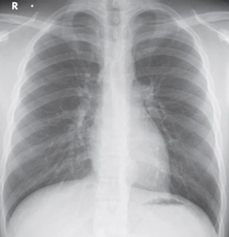 Chest radiograph on admission revealed a nodule adjacent to the thoracic vertebrae (arrows).
