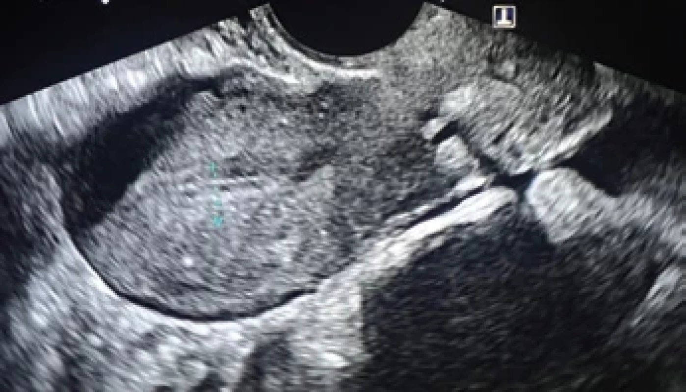 Fotografie zobrazující dělohu, štěrbinovitou dutinu děložní s endometriem v šíři 6 mm. </br>Fig. 1. Ultrasound photograph showing the uterus, a slit-like uterine cavity with a 6 mm wide endometrium.