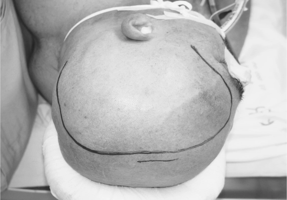 Poloha hlavy nemocného při operaci
Pic. 2. The patient’s head positioning during the procedure